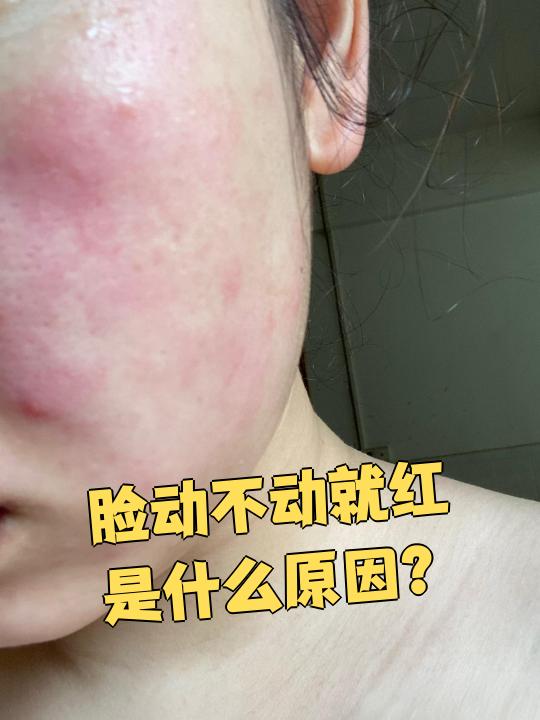 脸动不动就红可能和这些原因有关:环境刺激,过