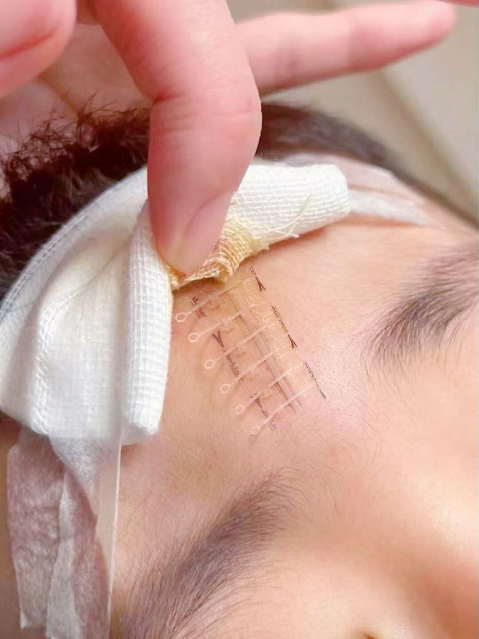 娃头上的缝针疤痕竟被这玩意搞定了 真的!真的!真的!