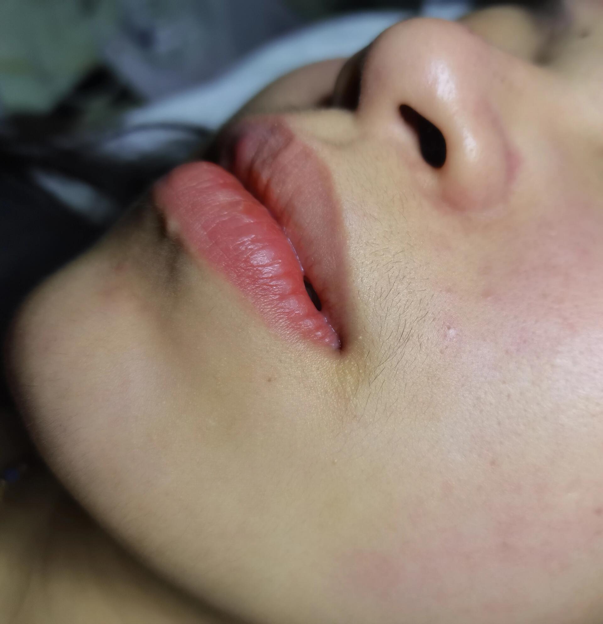 唇部脱毛对比图精致不是一点点整个肤色都亮