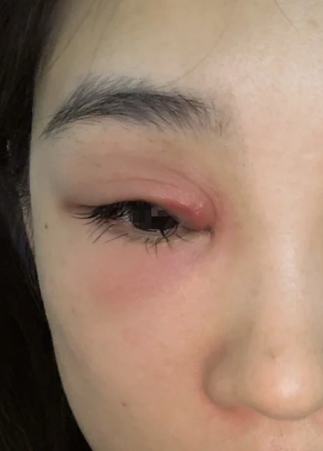 比如眼部进入异物,残留在睑结膜或结膜囊上,眨眼时角膜受刺激就会痛