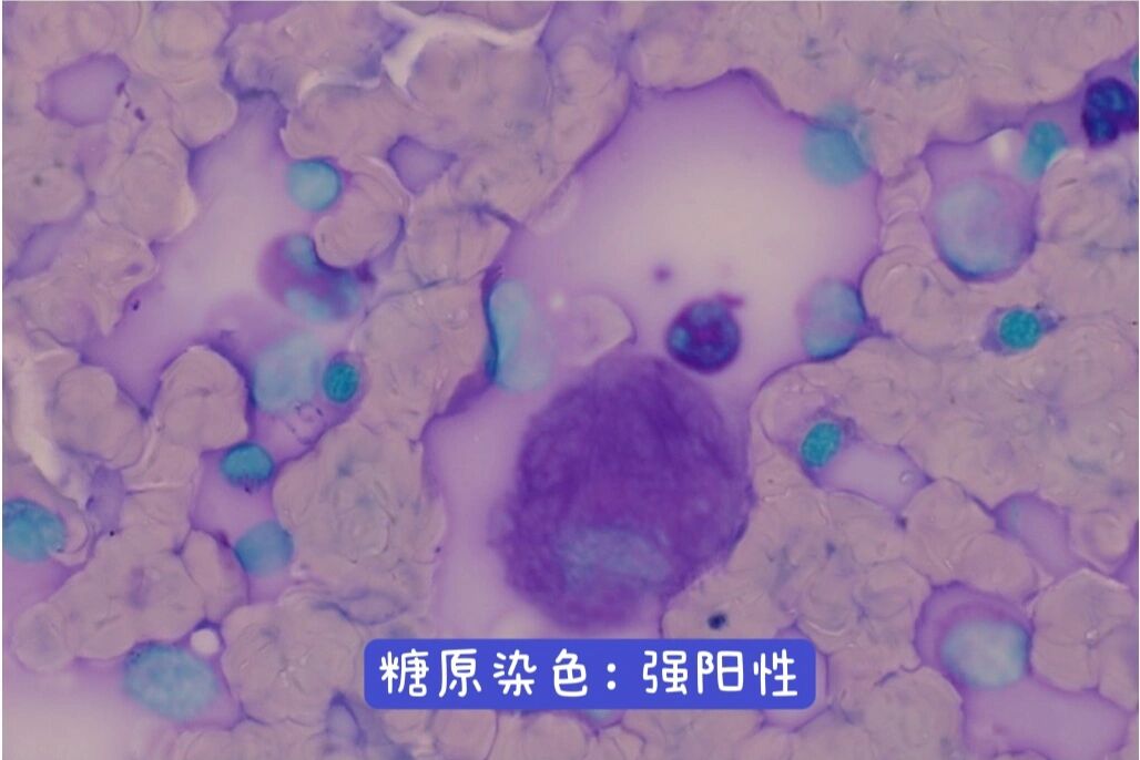 戈谢细胞#形态学介绍 95戈谢病(gaucher disease,gd)是一种常