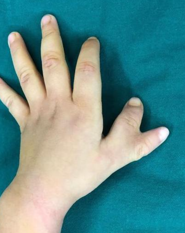 拇指畸形是否需要治疗要看具体情况,主要靠手术治疗