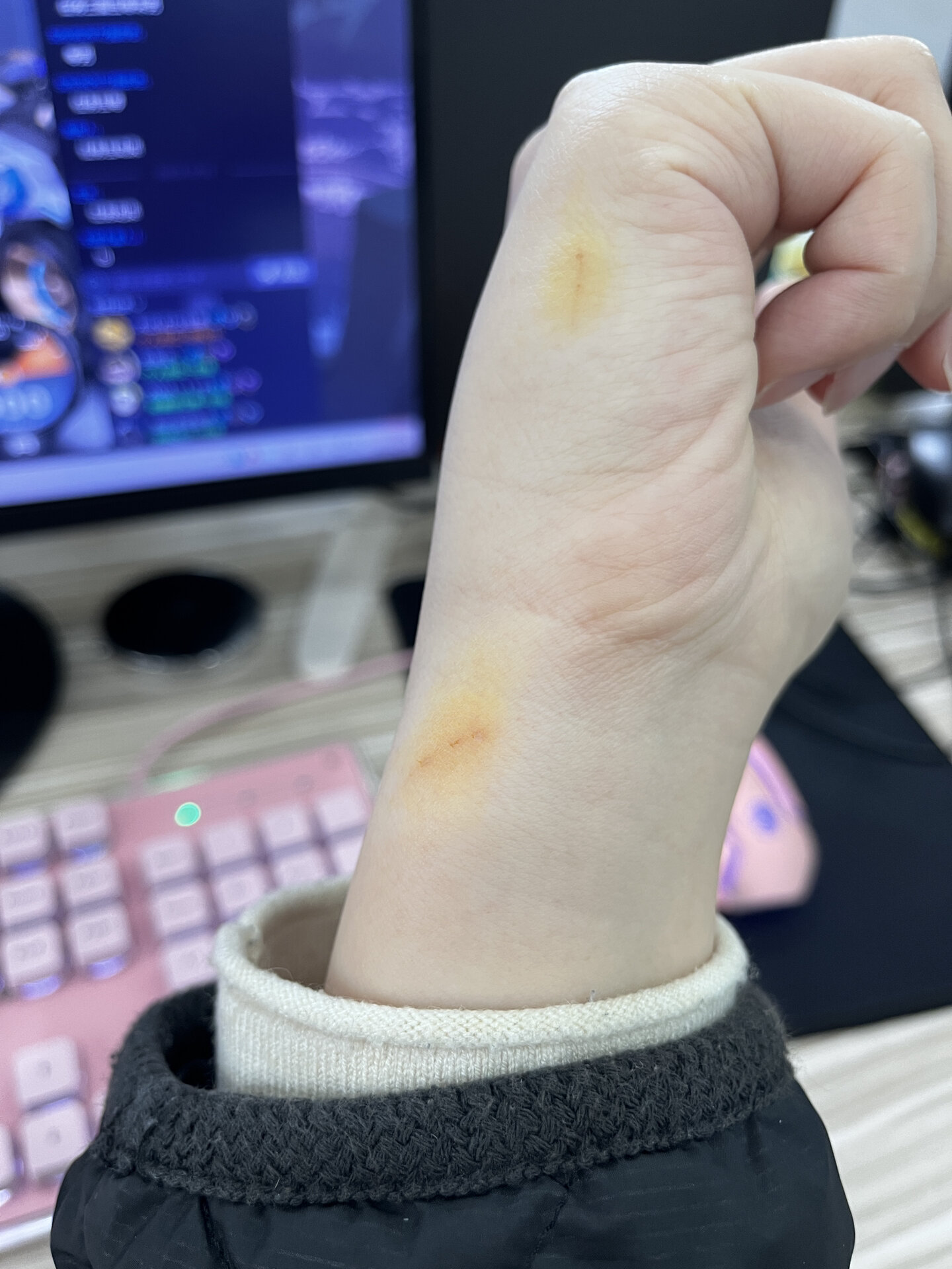 被捡到的流浪猫抓到了破了一点皮 被捡到的流浪猫喂药的时候抓破了一