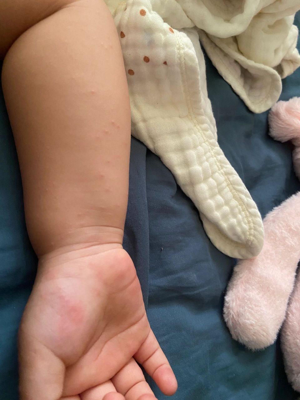 沙土性皮炎 更新一下:就是我娃儿确实涂丹皮酚就好了,一天两次,涂了一