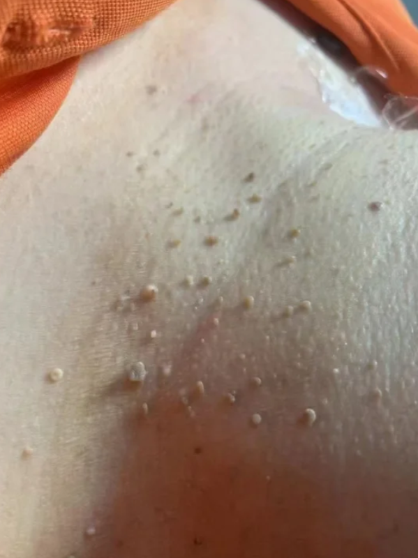 hpv皮肤丘疹是常见的皮肤赘生物,通常表现为乳头状,鸡冠状或菜花状