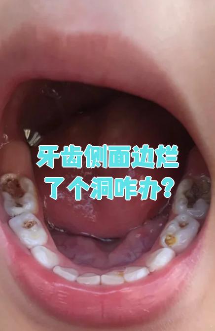 牙齿侧面烂了个洞,最常见的原因是龋齿或牙齿磨损
