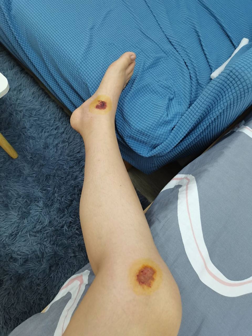 摔伤第三天 感觉脚比前几天痛了怎么回事,刚摔第一天我还能把电动车大