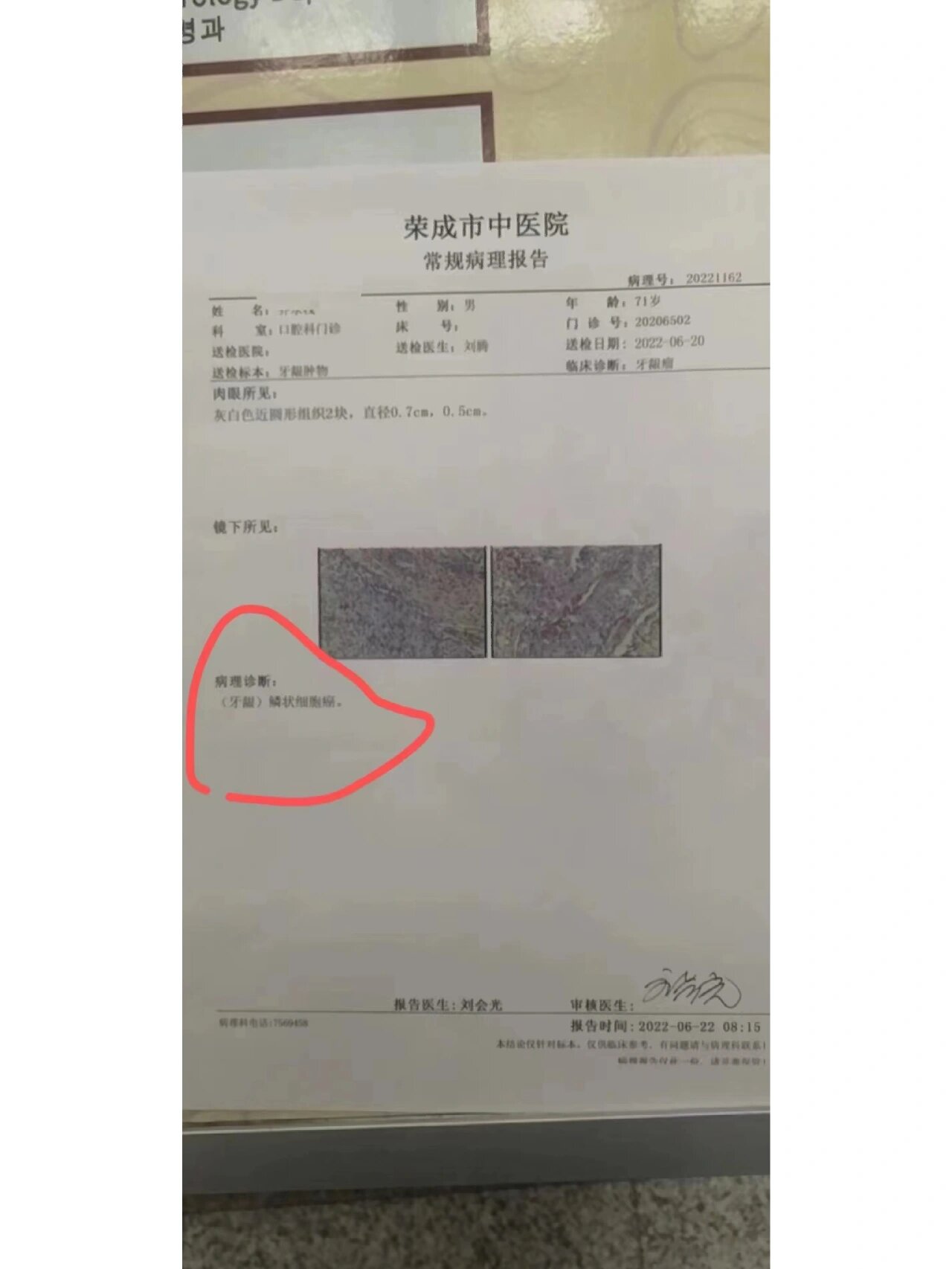 牙龈鳞状细胞癌服用安惠食药用菌40天的效果 女儿孝心感动上苍!