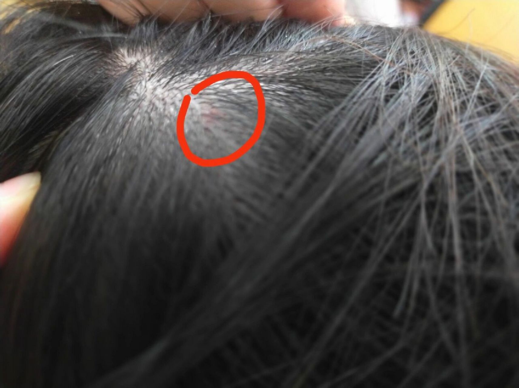 有没有人知道这是啥呀头上昨天晚上突然长了个包,红红的摸到会痛