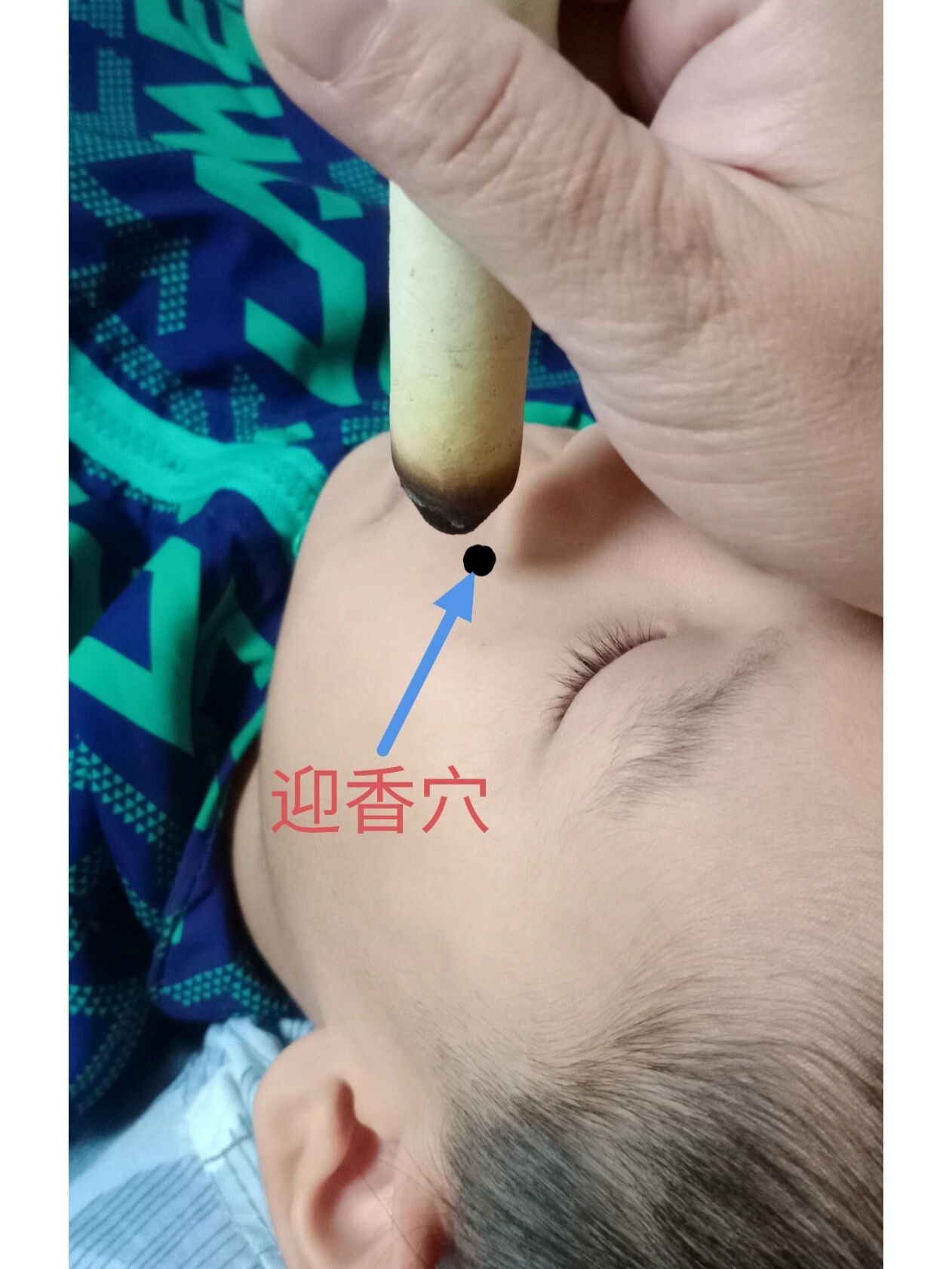 孩子告别慢性鼻炎77鼻窦炎【艾灸调理】 坚持十天,告别鼻炎,鼻窦炎