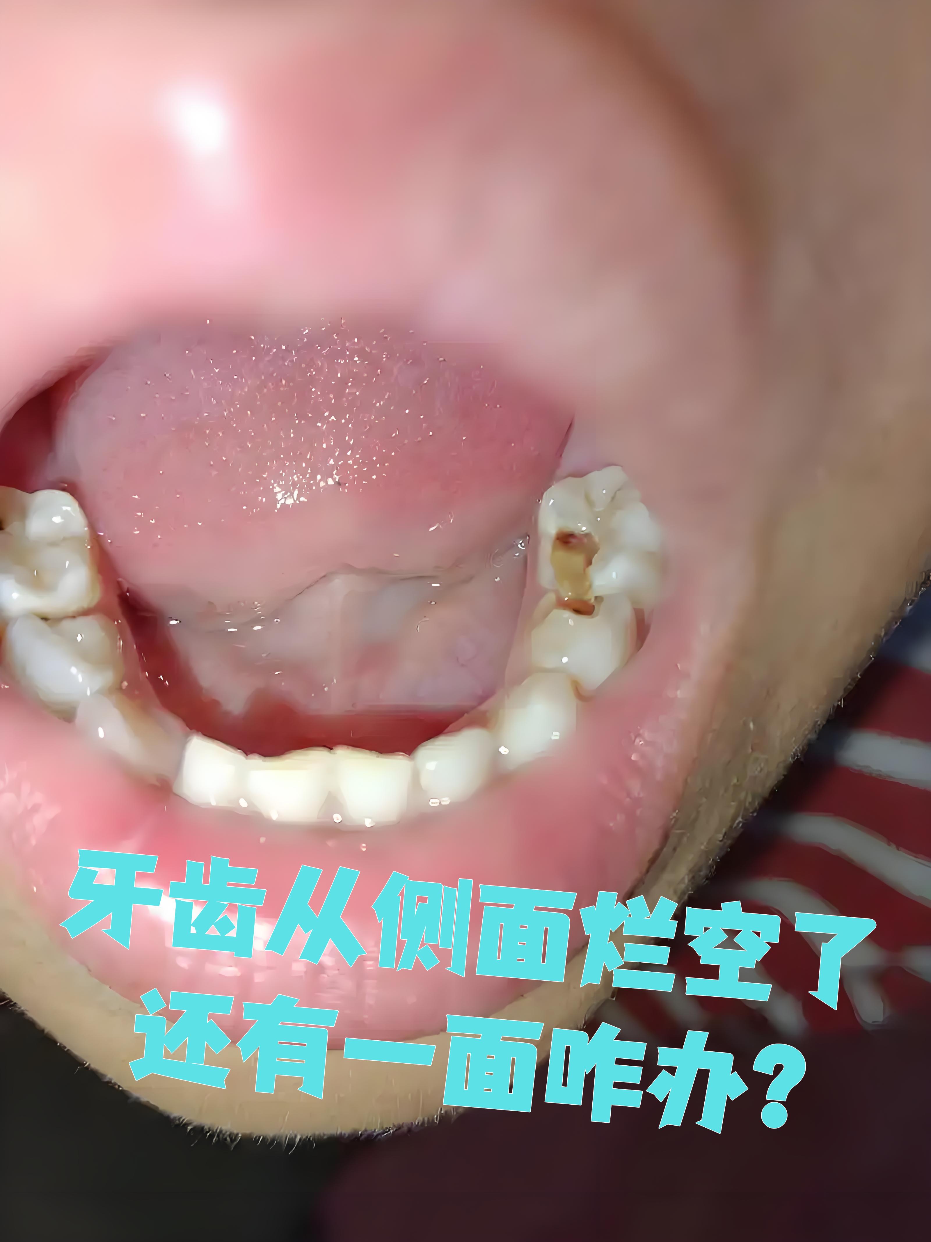 牙齿从侧面烂空了还有一面,这通常意味着龋病已经发展到一定程度