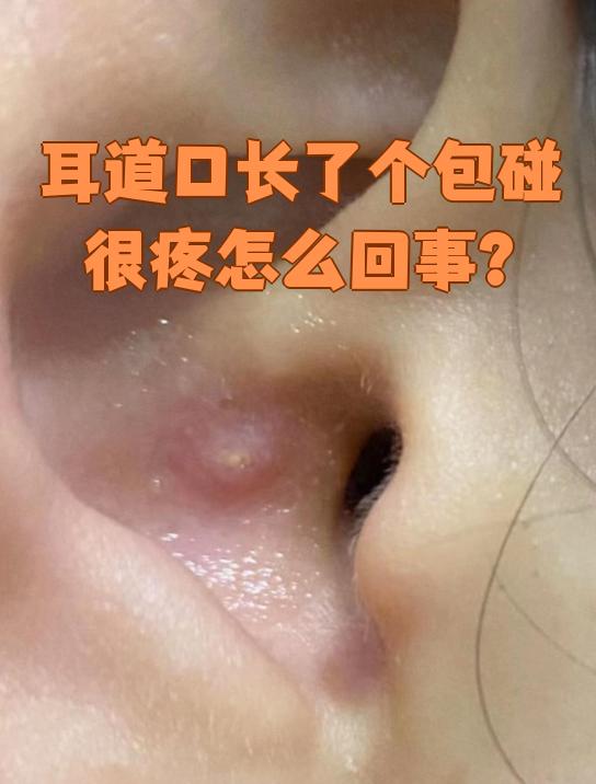 耳道口长了个包而且一碰就疼,这种情况最常见的就是外耳道疖肿或者