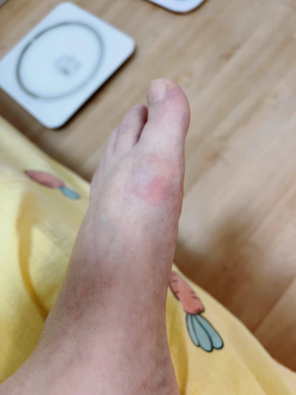 不吃药就500以上01 这几天降温了,又开始红肿疼,痛风脚一定要注意