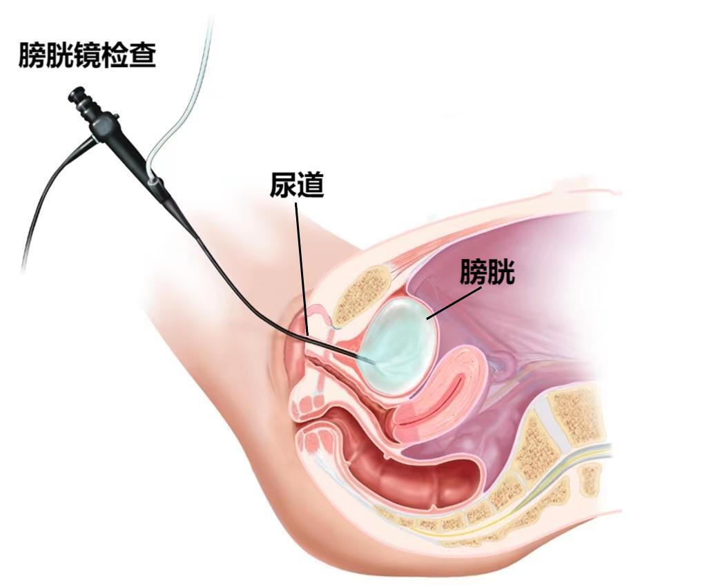 输尿管镜进镜技巧图片图片