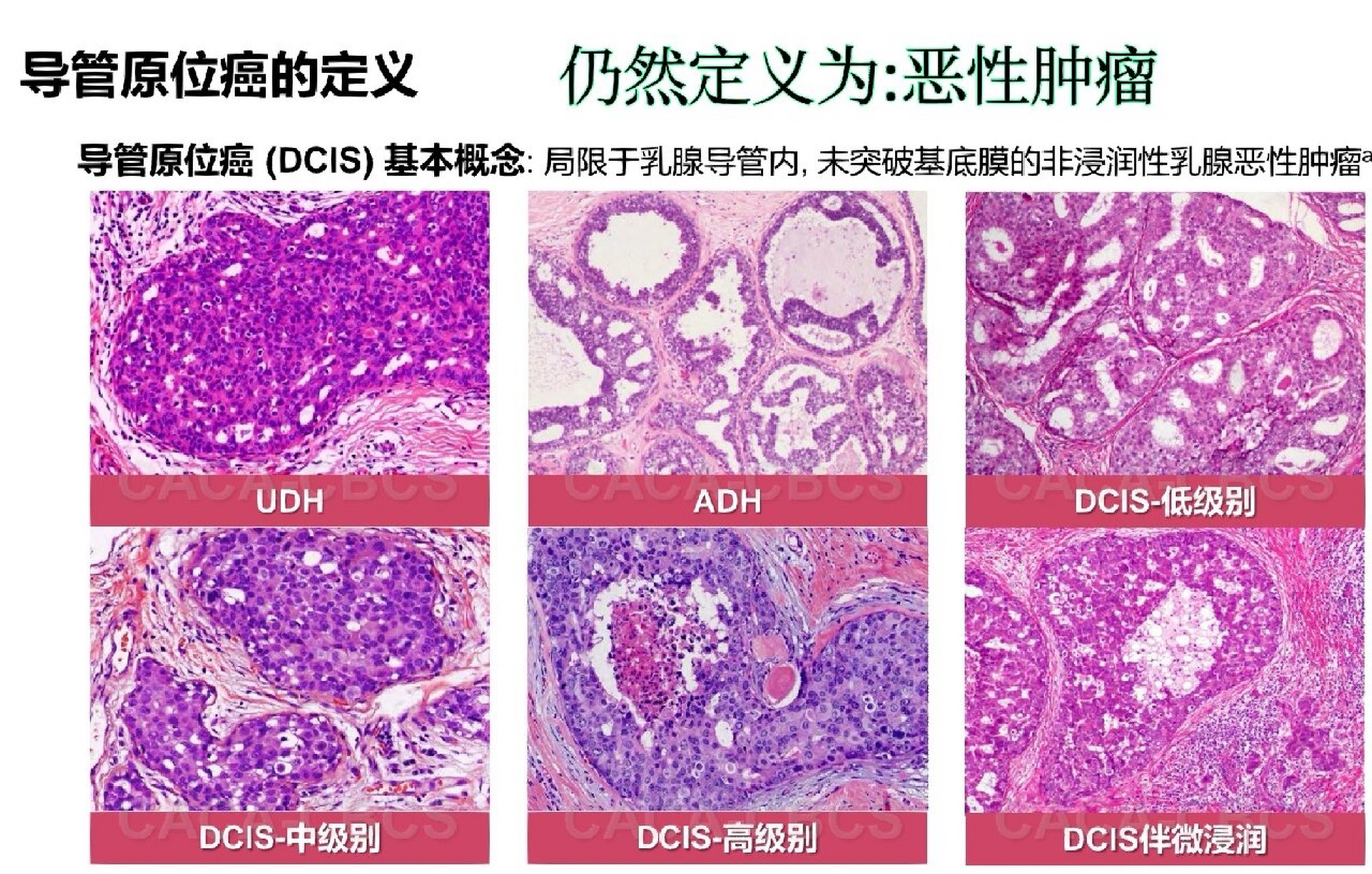 乳腺导管原位癌,可以不用放疗?