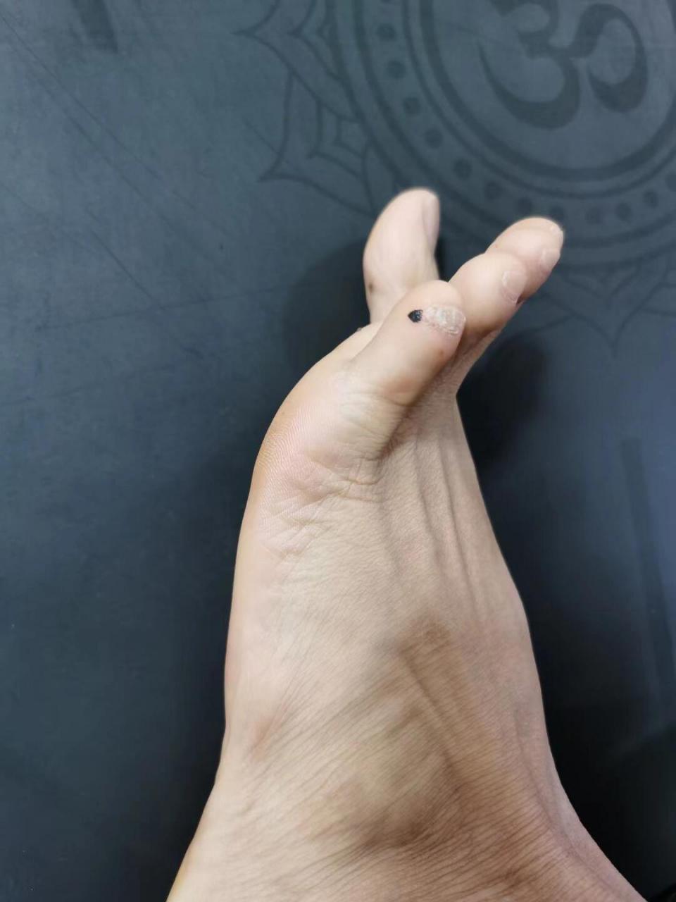 每日一穴 每日一穴 为家人健康护航 67至阴穴 67位置:小脚趾甲