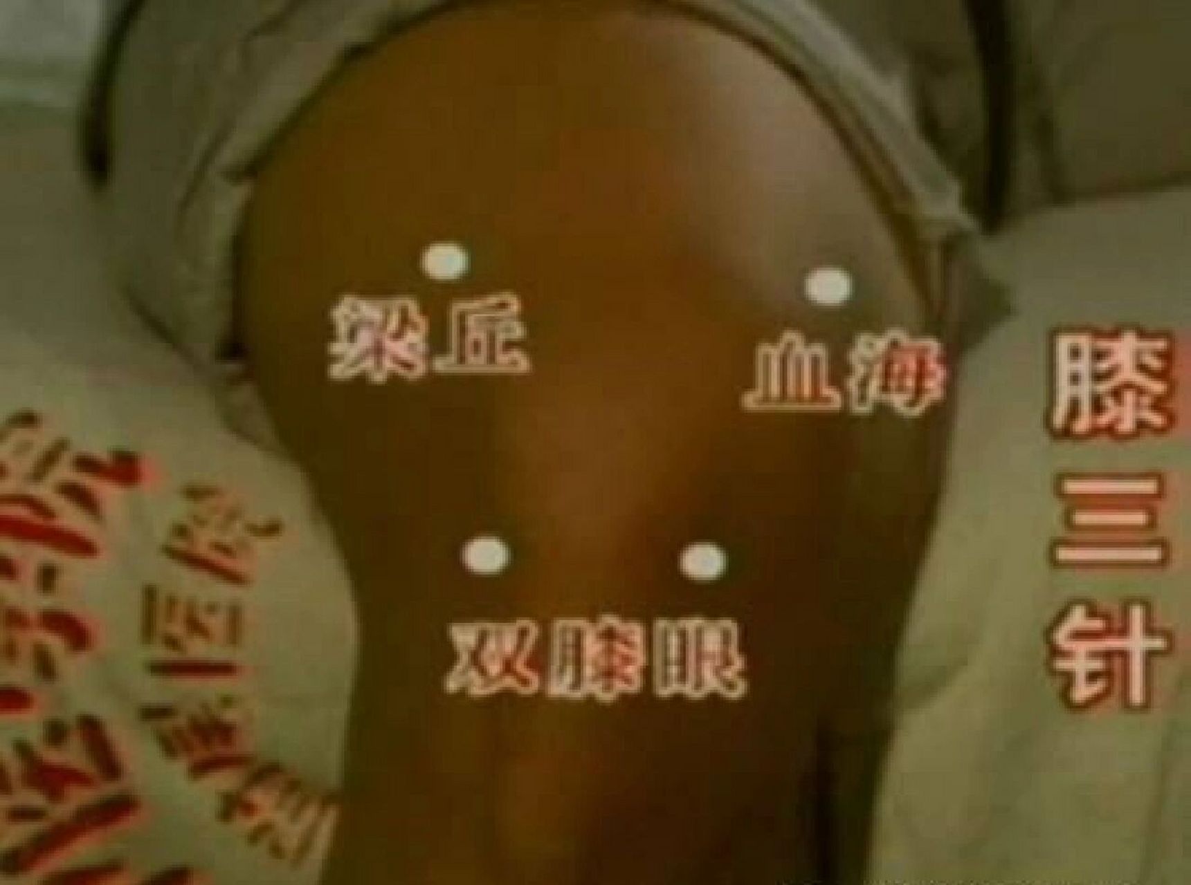 治疗膝关节疾病穴位介绍 "膝三针",顾名思义,针对膝关节疾病而选穴组