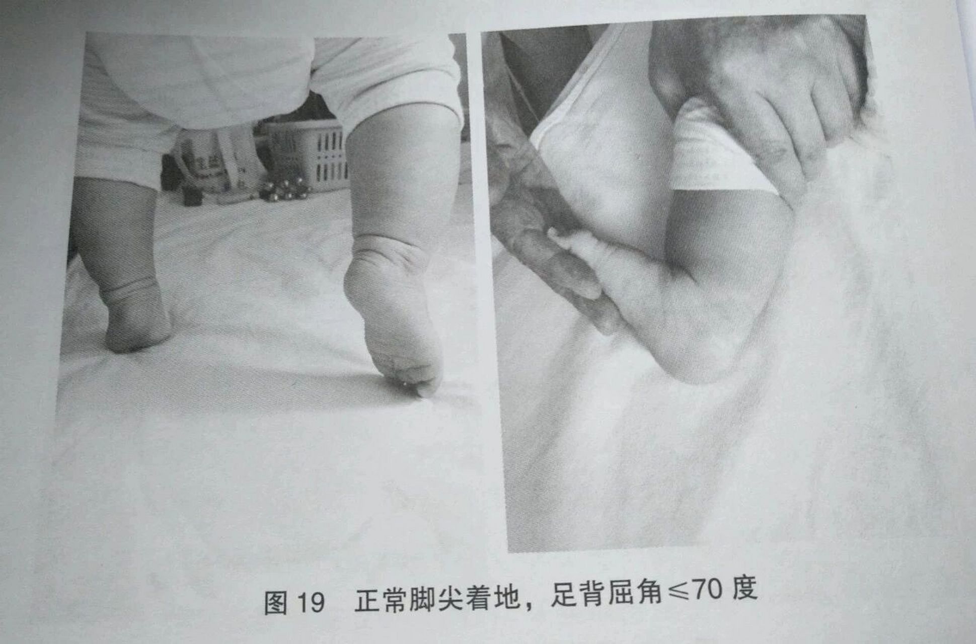 宝宝尖足问题 很多家长在网上问,"我家宝宝足尖步,有没有事情啊?