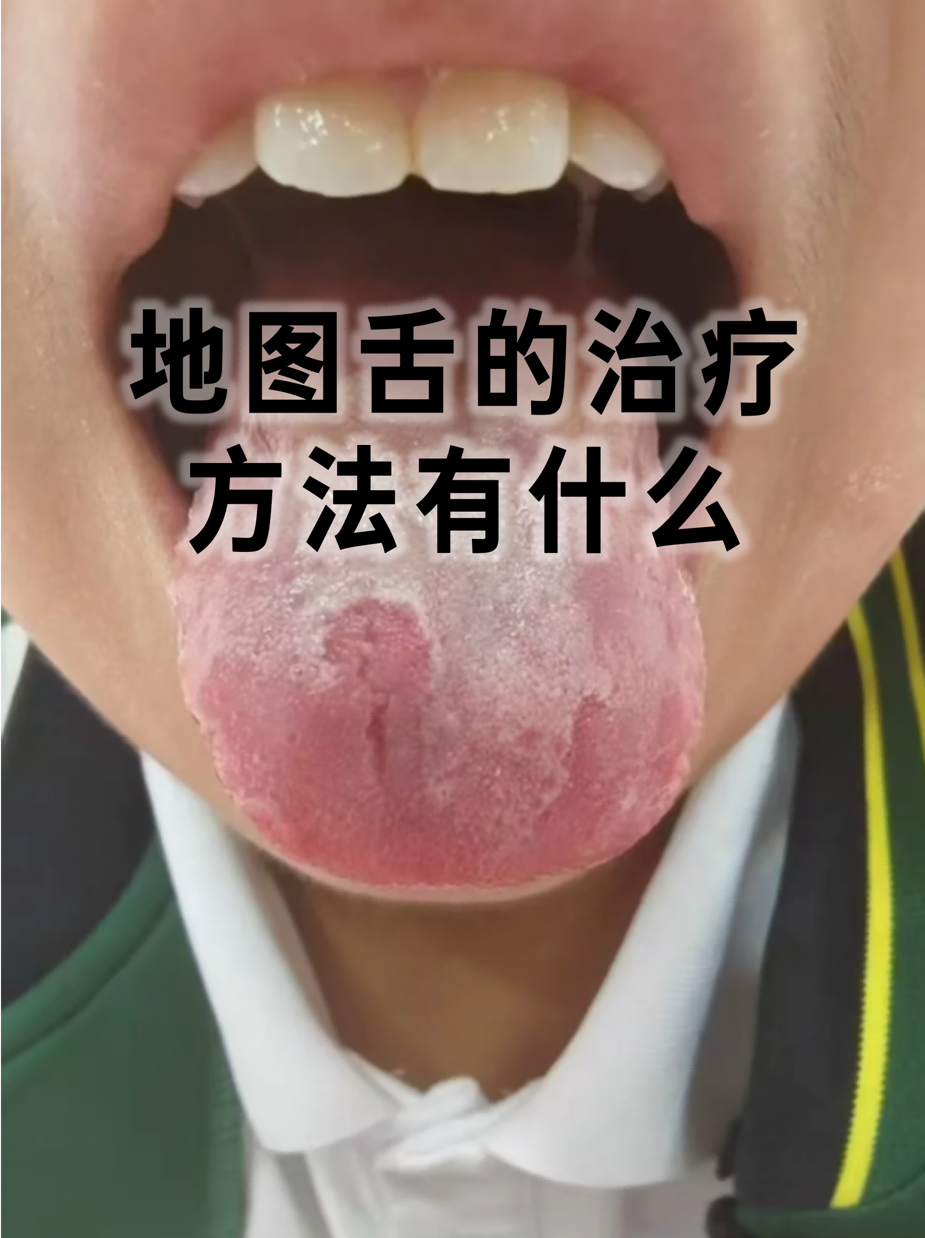 地图舌的治疗方法有什么