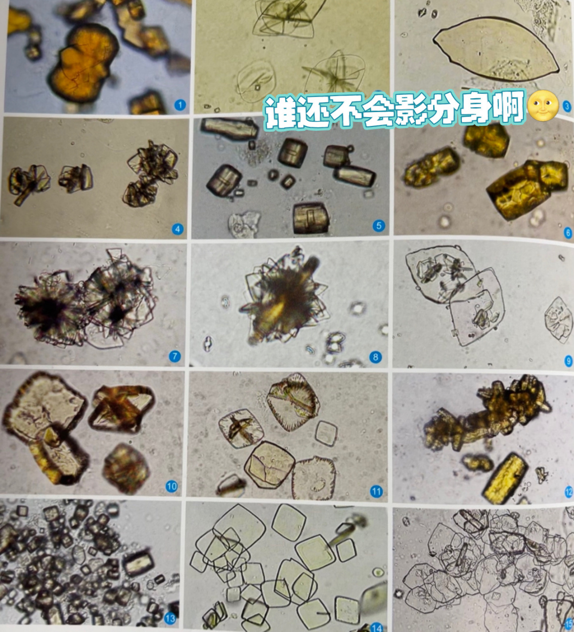 嘘嘘里面的结晶之磷酸铵镁结晶和尿酸结晶     	 先说磷酸铵镁结晶吧