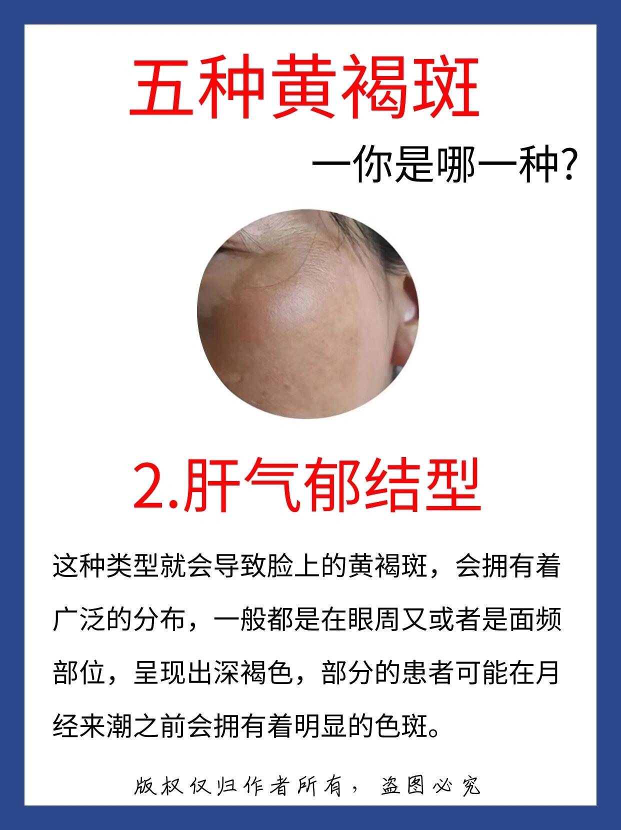 5种黄褐斑‼️快来看看你是属于哪一种🍀 1️⃣脾虚型 2