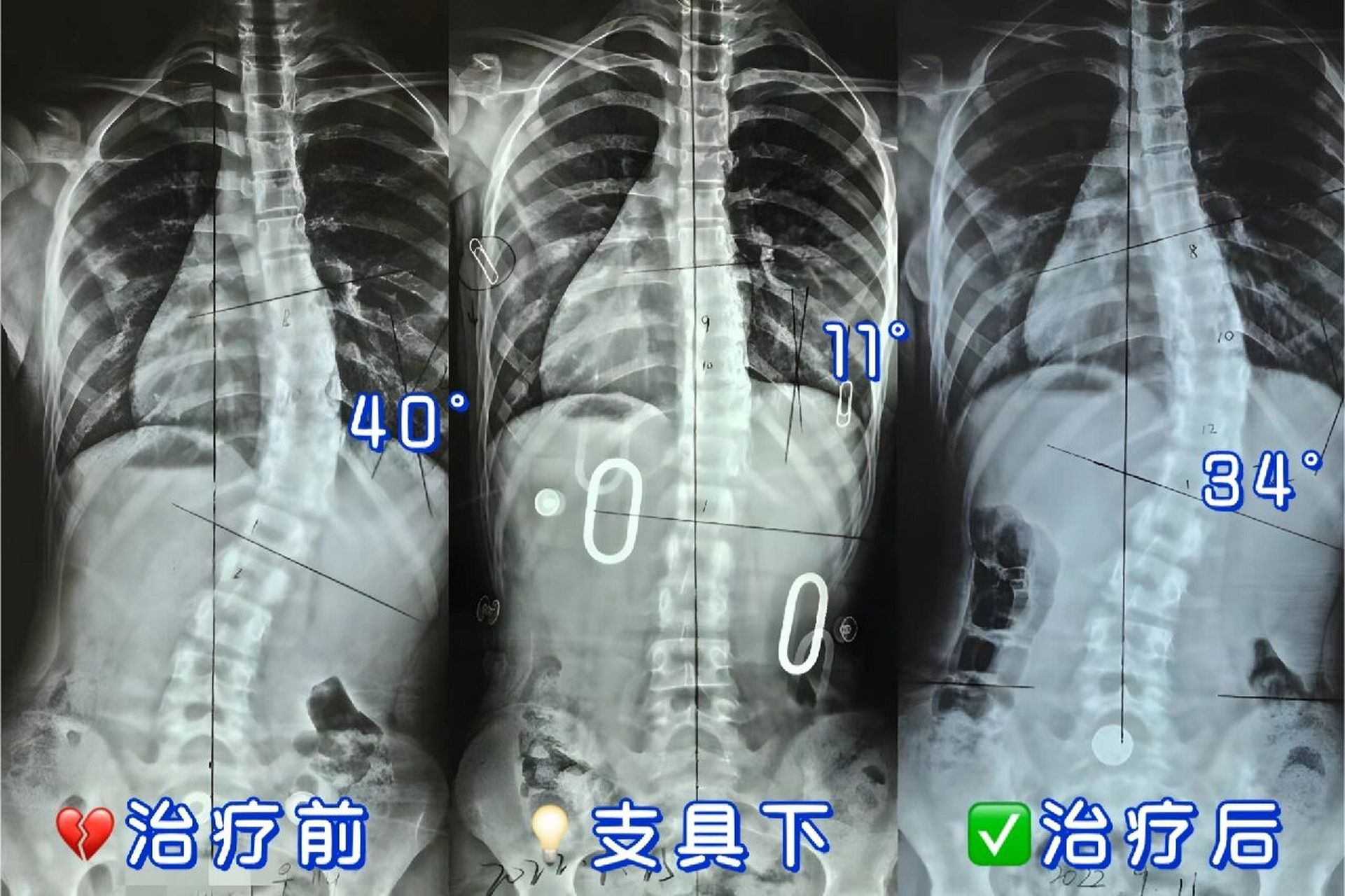 脊柱侧弯超过40度,不一定要做手术05 赵同学979911岁那年,是一