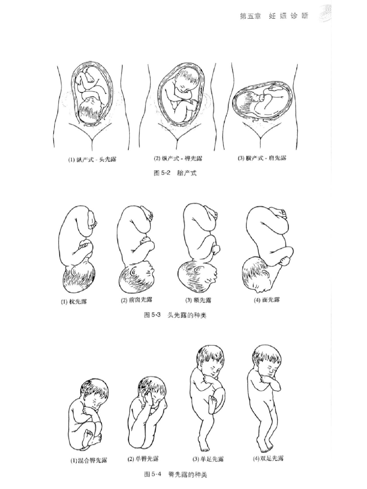 胎儿的头位一般分为三类 头位