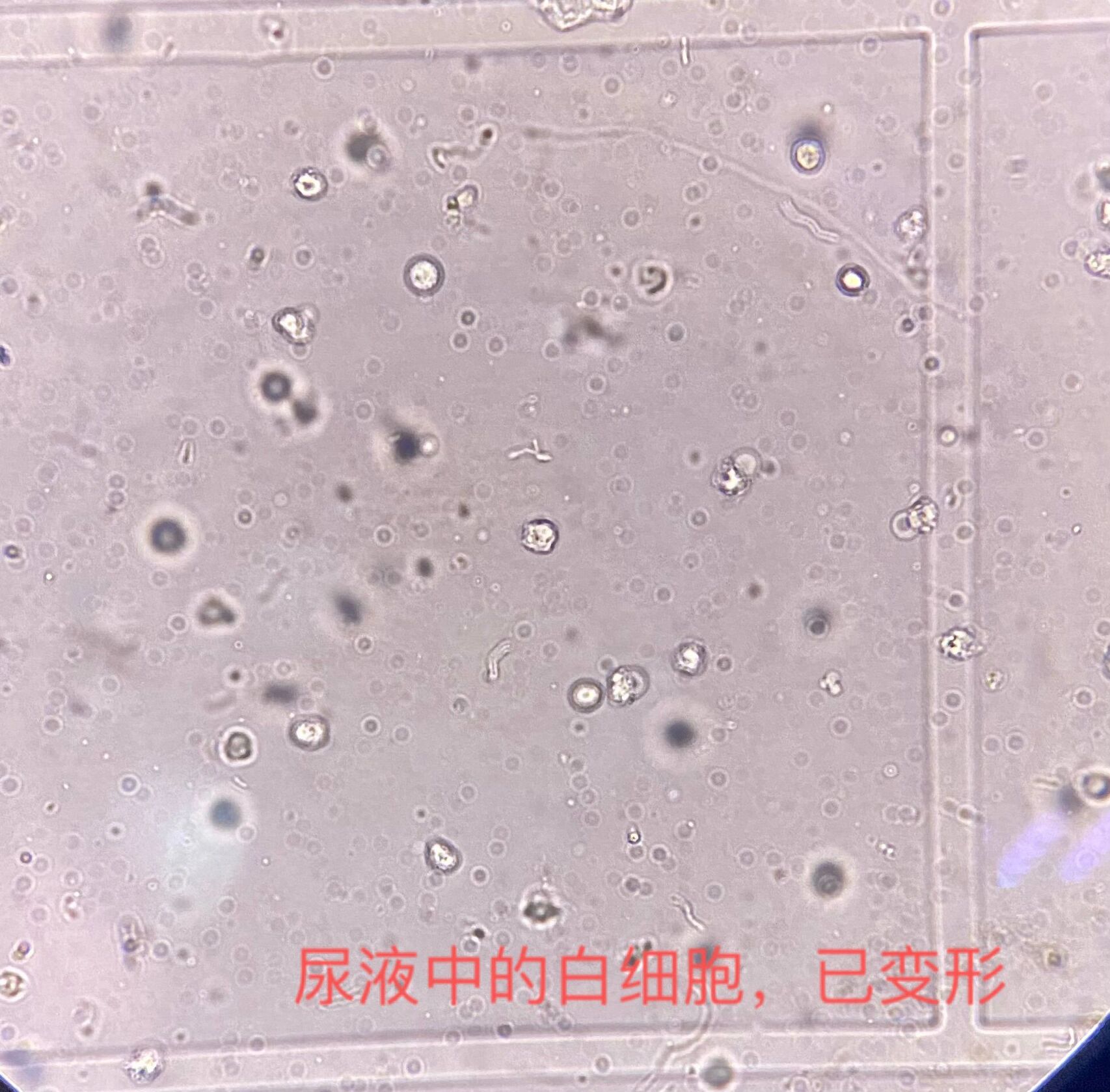 尿液中的红细胞和白细胞     拍出来和显微镜下看到的有一定差别