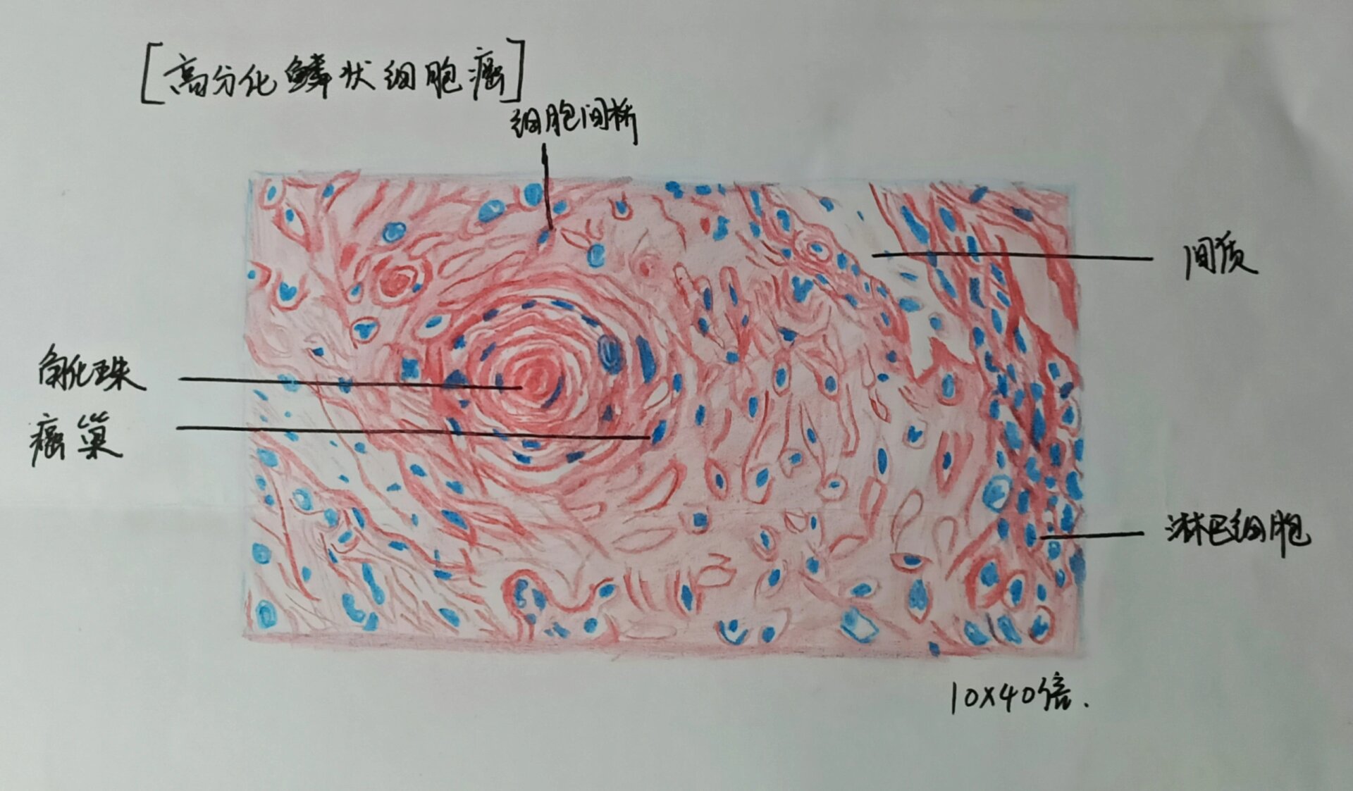 胃溃疡红蓝铅笔图图片