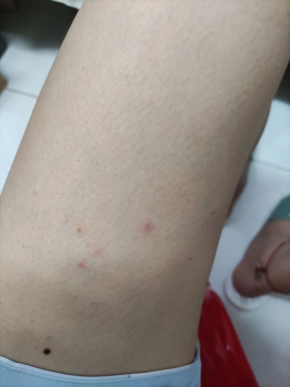 有朋友知道腿上长的啥玩意吗 洗完澡出来大小腿上长了好几个这种红