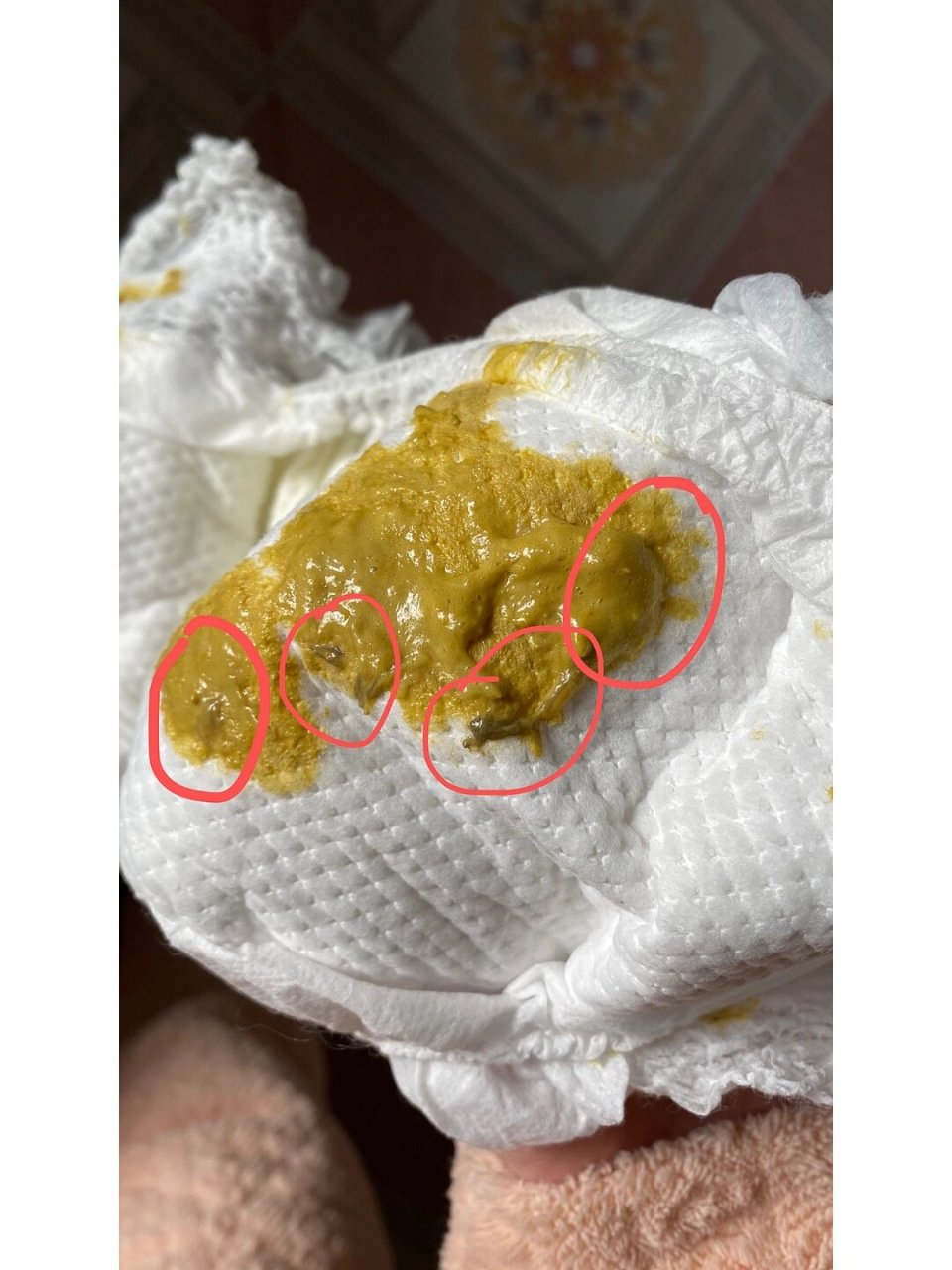 宝宝六个月突然拉黑色粘液 宝宝平时大便挺规律基本一天一次,黄色糊