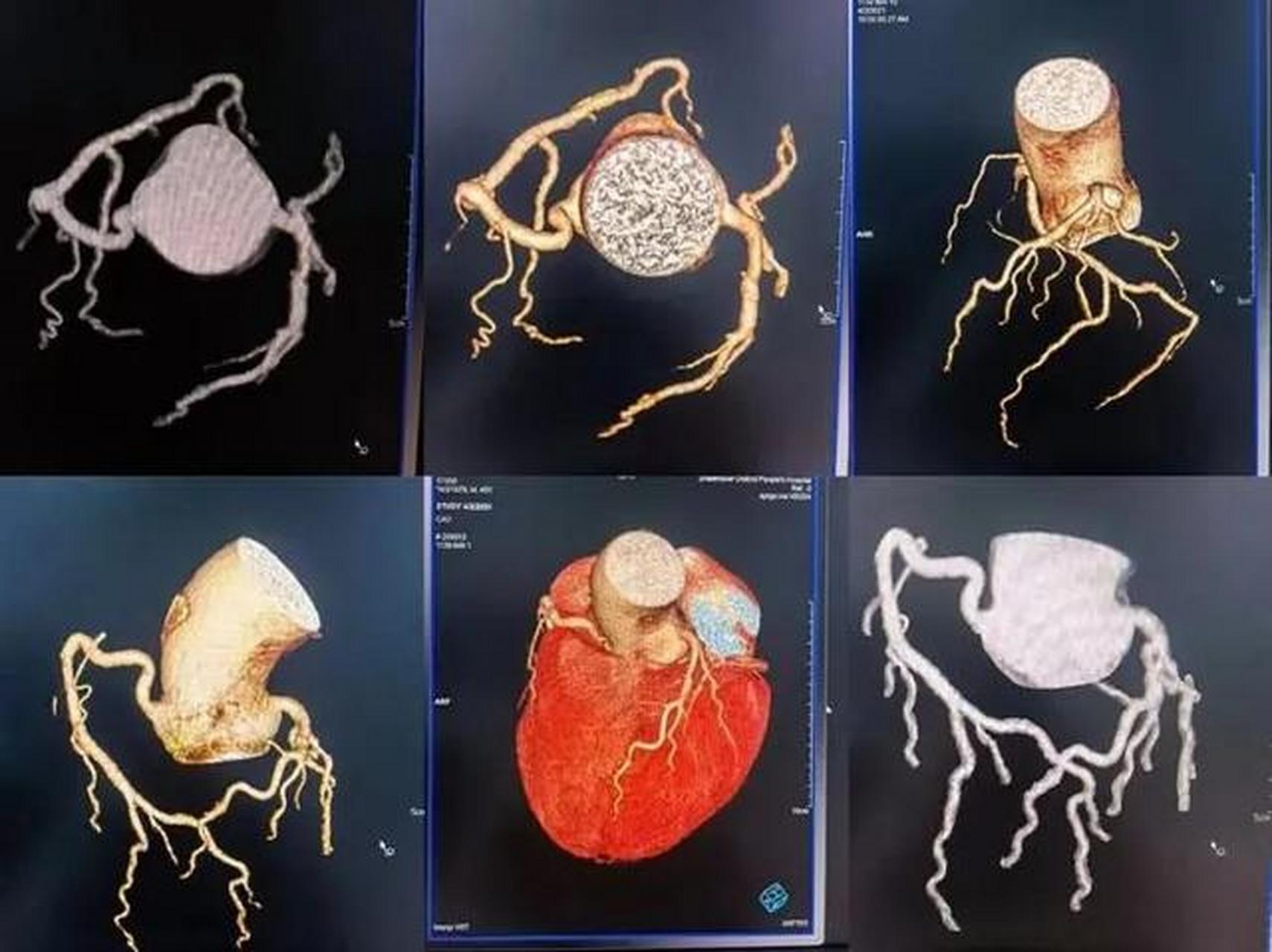 冠脉ct和冠脉cta,两种检查一样吗?冠脉ct是一个简称,就是冠脉cta,那个