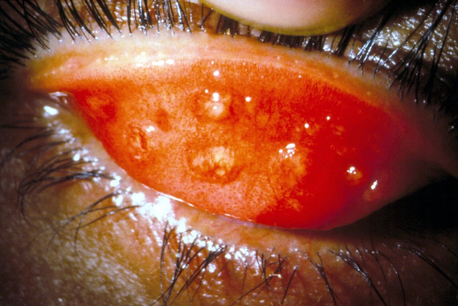 沙眼 沙眼(trachoma)是由沙眼衣原体感染所致的一种慢性传染性结膜角