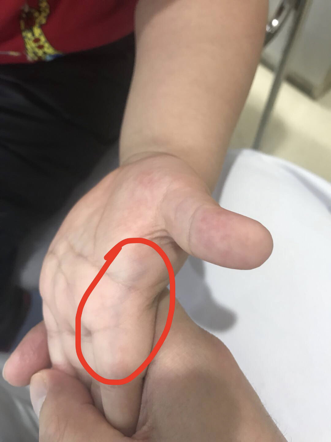小儿指纹色紫红,家长要当心 小儿指纹的变化可以反映儿童的虚实寒热.