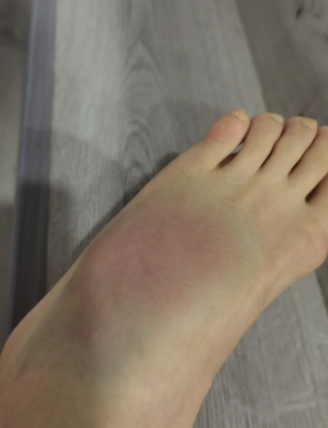 脚崴了感觉里面有气,这其实是局部肿胀的表现