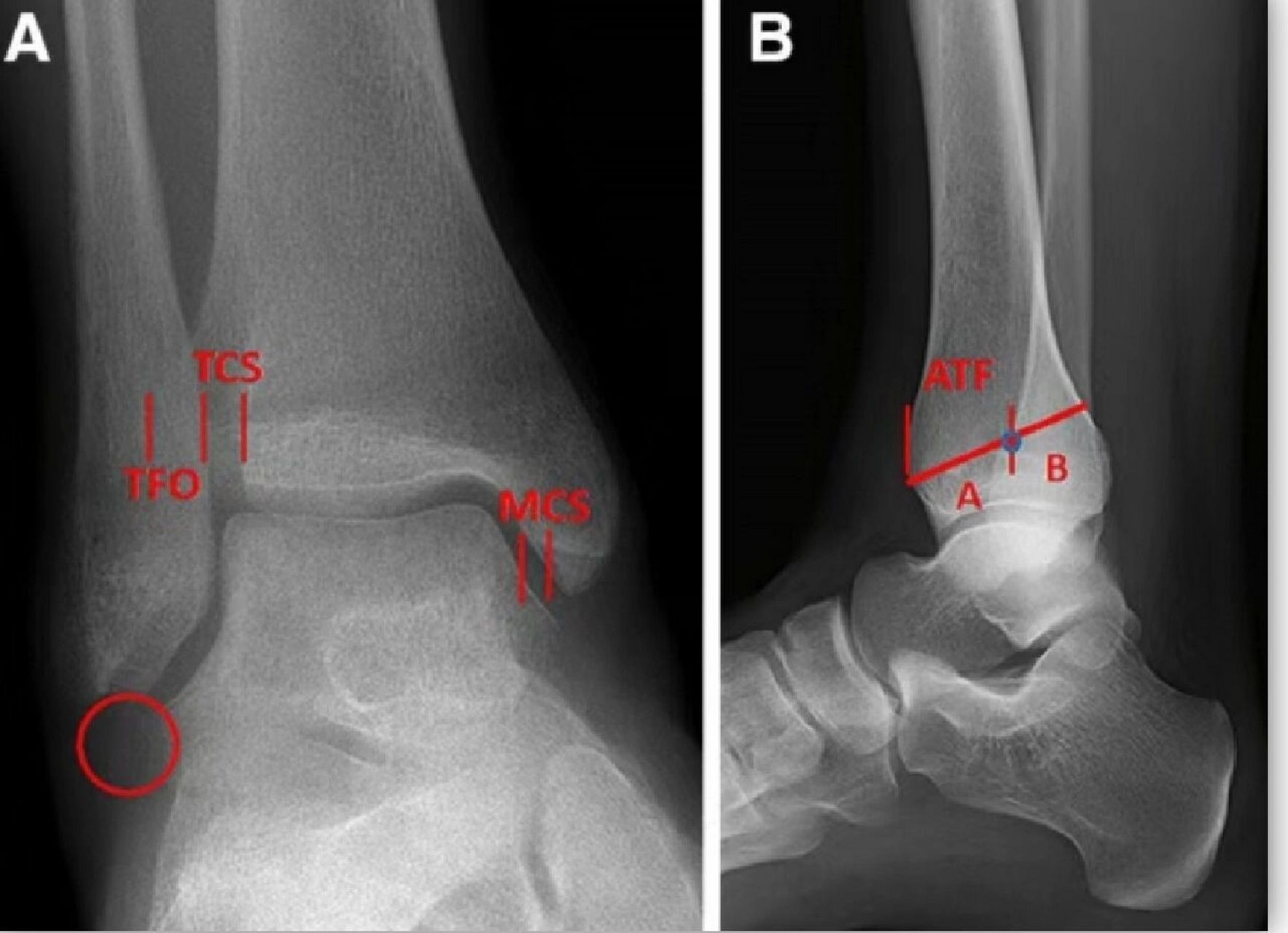 如何拍出标准的踝关节正侧位 我们先看一张较为标准的踝关节正文,看