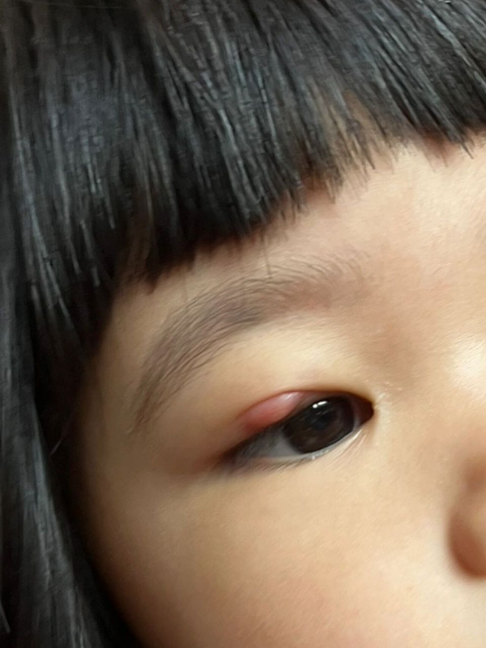 儿童霰粒肿 我的宝宝2岁多眼睛长了大包 前几个月 孩子眼睛大包不经意
