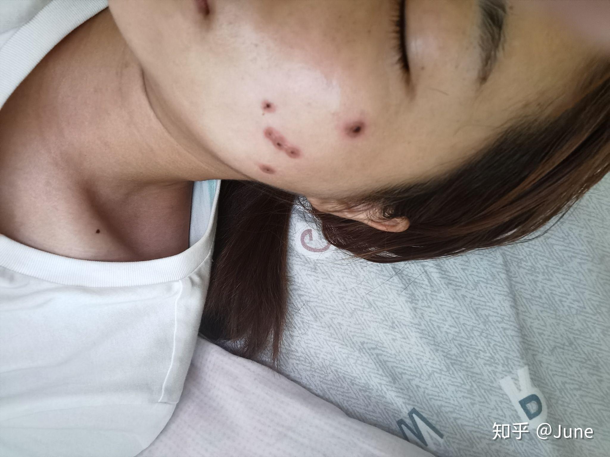 液氮冷冻点痣记录两年了