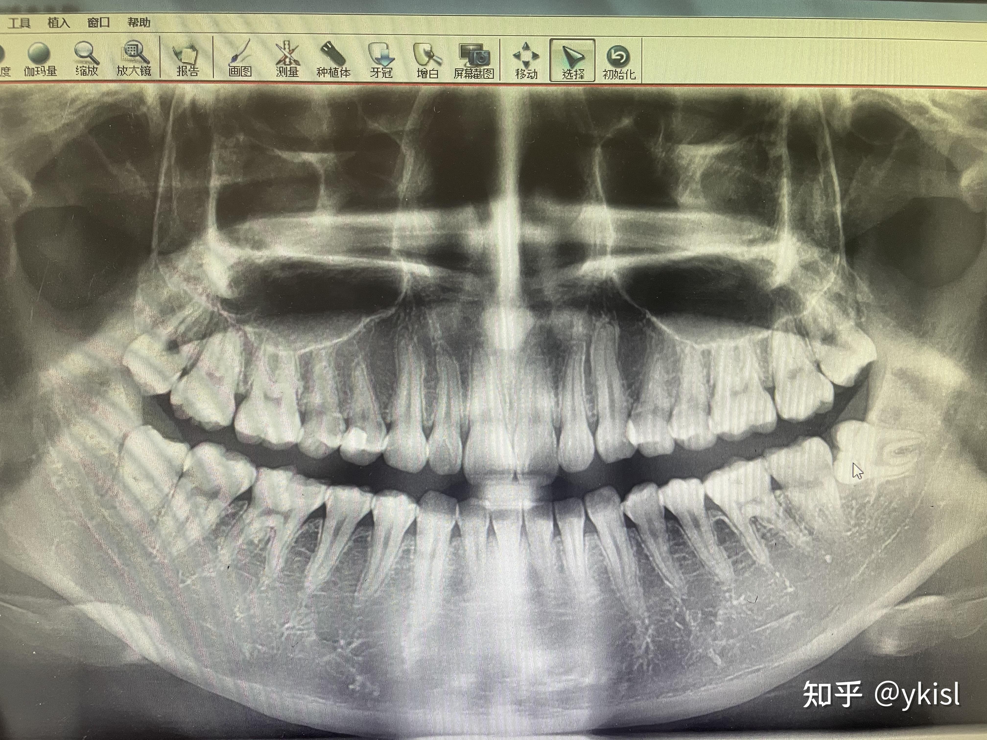 拔横向阻生智齿到底疼不疼