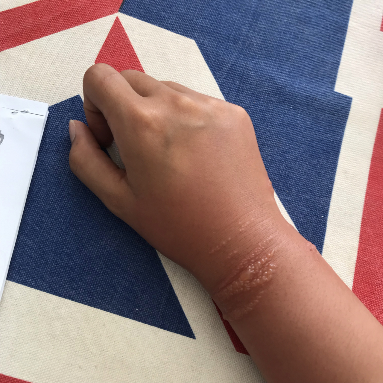 为什么不要触碰海洋生物之水母蜇伤 嗯好久以前的一次水母蜇伤,在水面