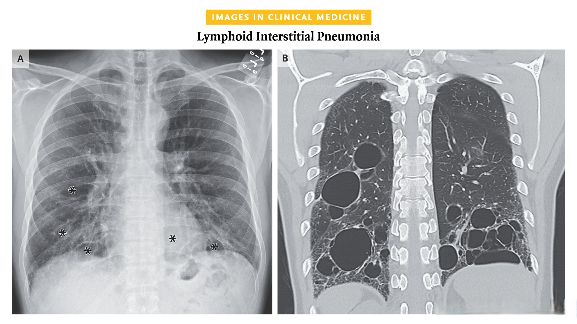 淋巴细胞间质性肺炎 一名既往健康的 37 岁男性因干咳,疲劳和口干 10