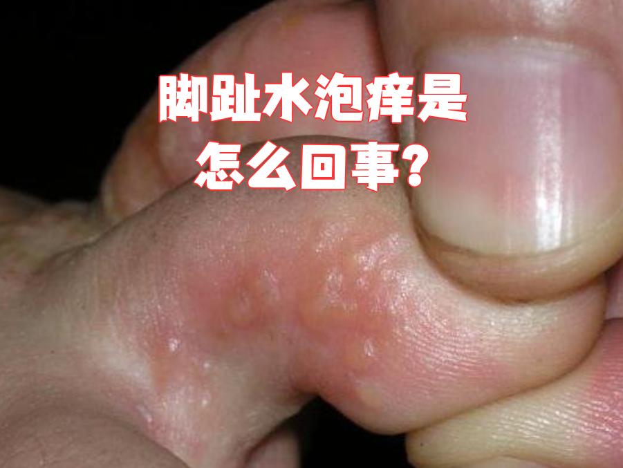 为什么脚趾缝会痒会烂百科在线 为什么脚趾缝会痒会烂百科在线
