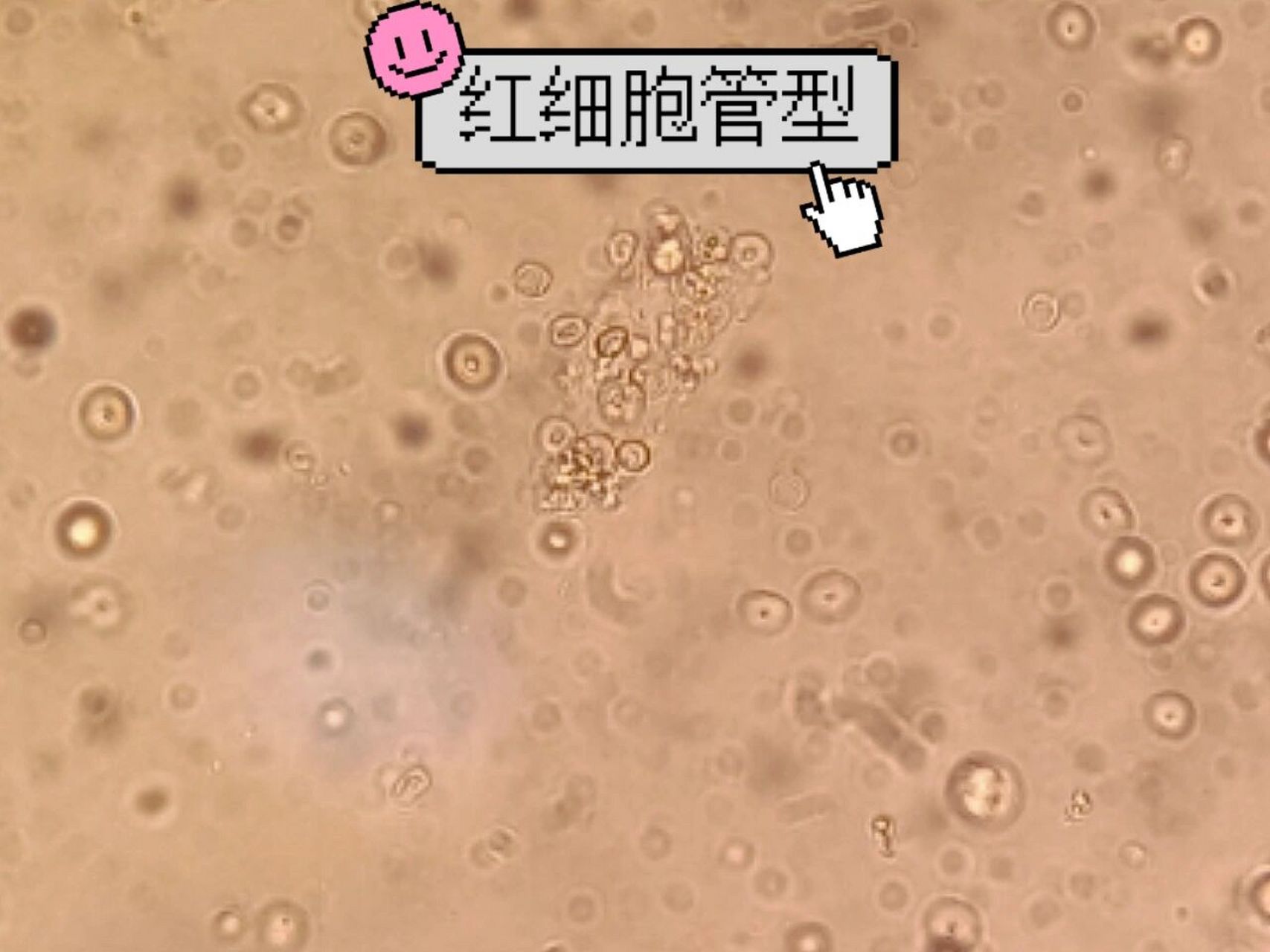 [尿镜检]白细胞管型红细胞管型傻傻分不清 94把镜下白细胞和红细胞