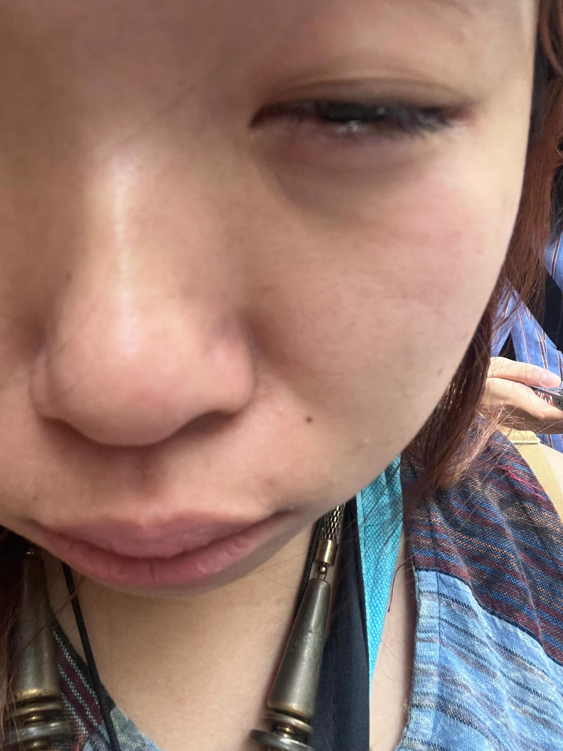 跑完800m鼻子里面真的好痛 到底为什么会这样 鼻孔特别疼一扯着就流