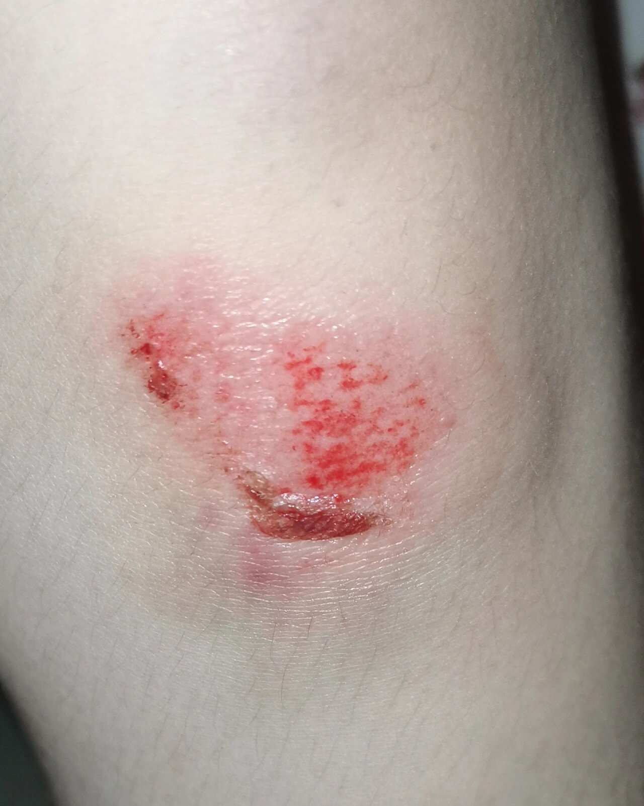 希望磕破的膝盖快点好起来