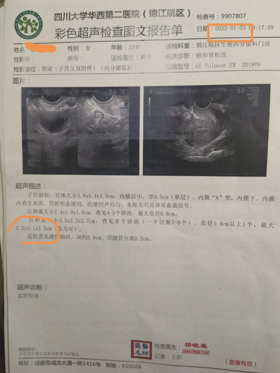 卵泡黄素化 99卵泡黄素化,简称lufs,全称叫"未破裂卵泡黄素化综合征