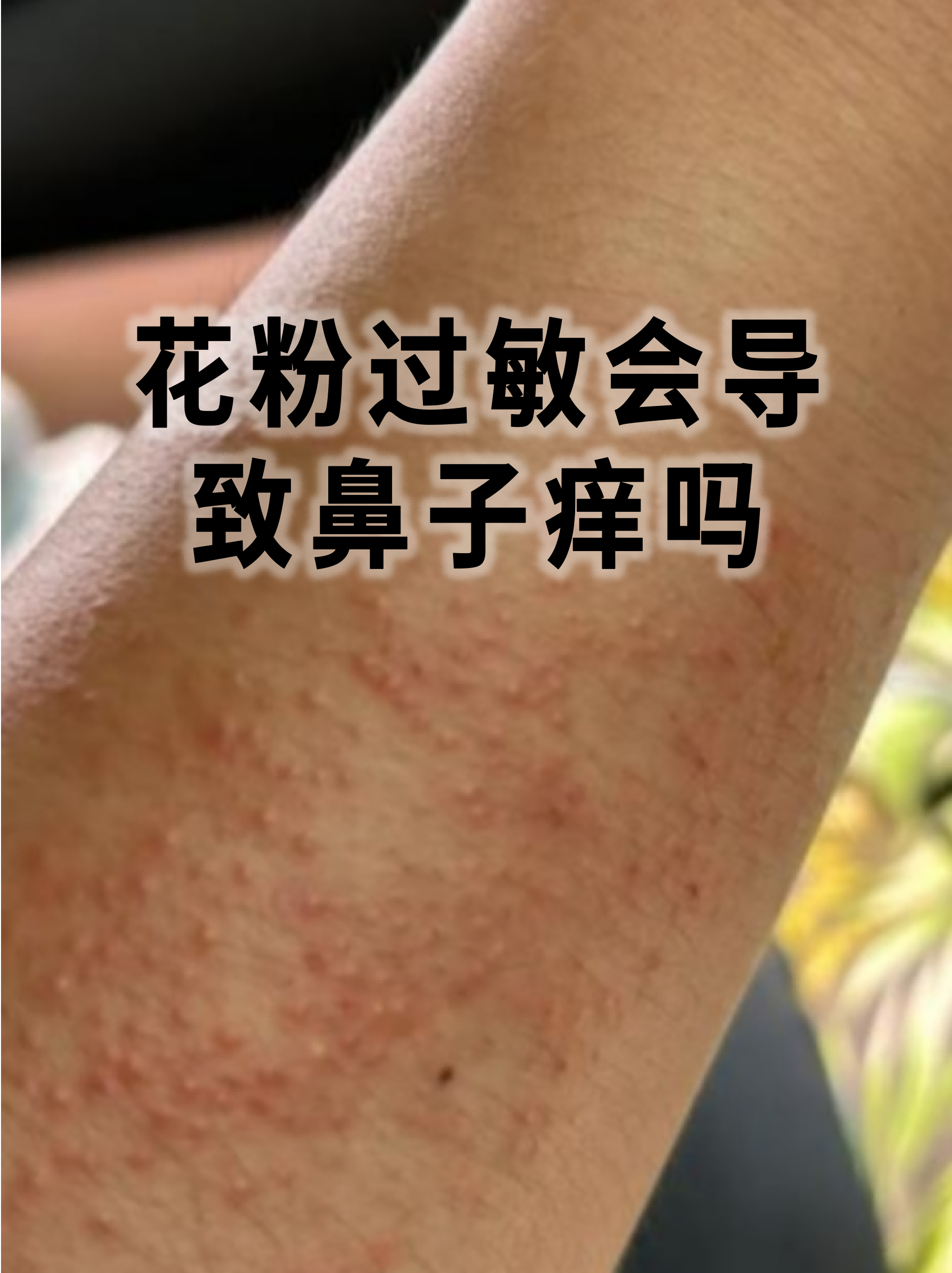 这种过敏反应源于免疫系统对花粉的过度防御,引发鼻腔黏膜的炎症反应