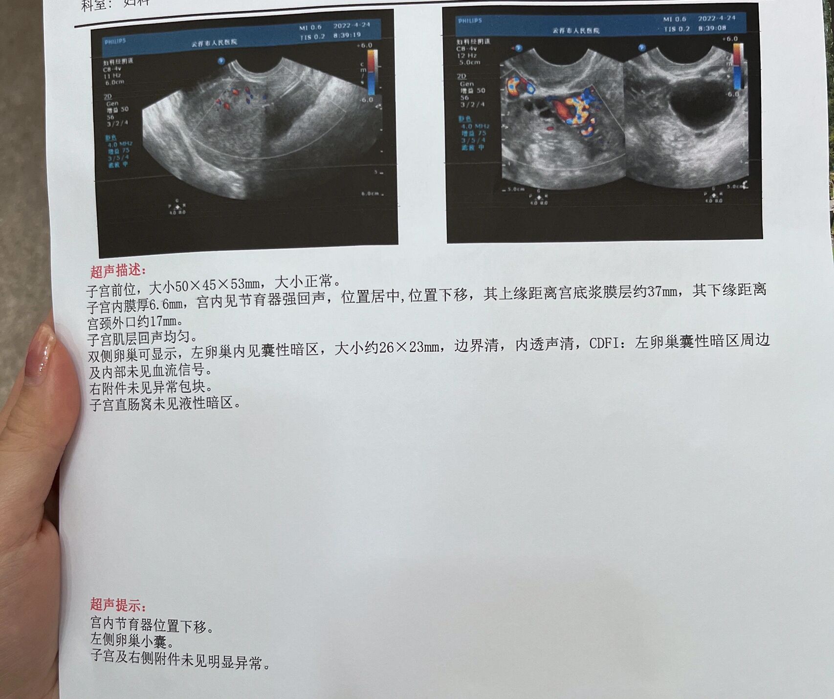 曼月乐环下移