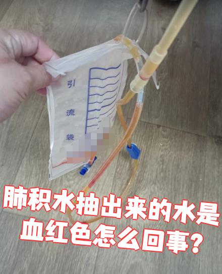 肺积水抽出来的水是血红色,这种情况需要重视