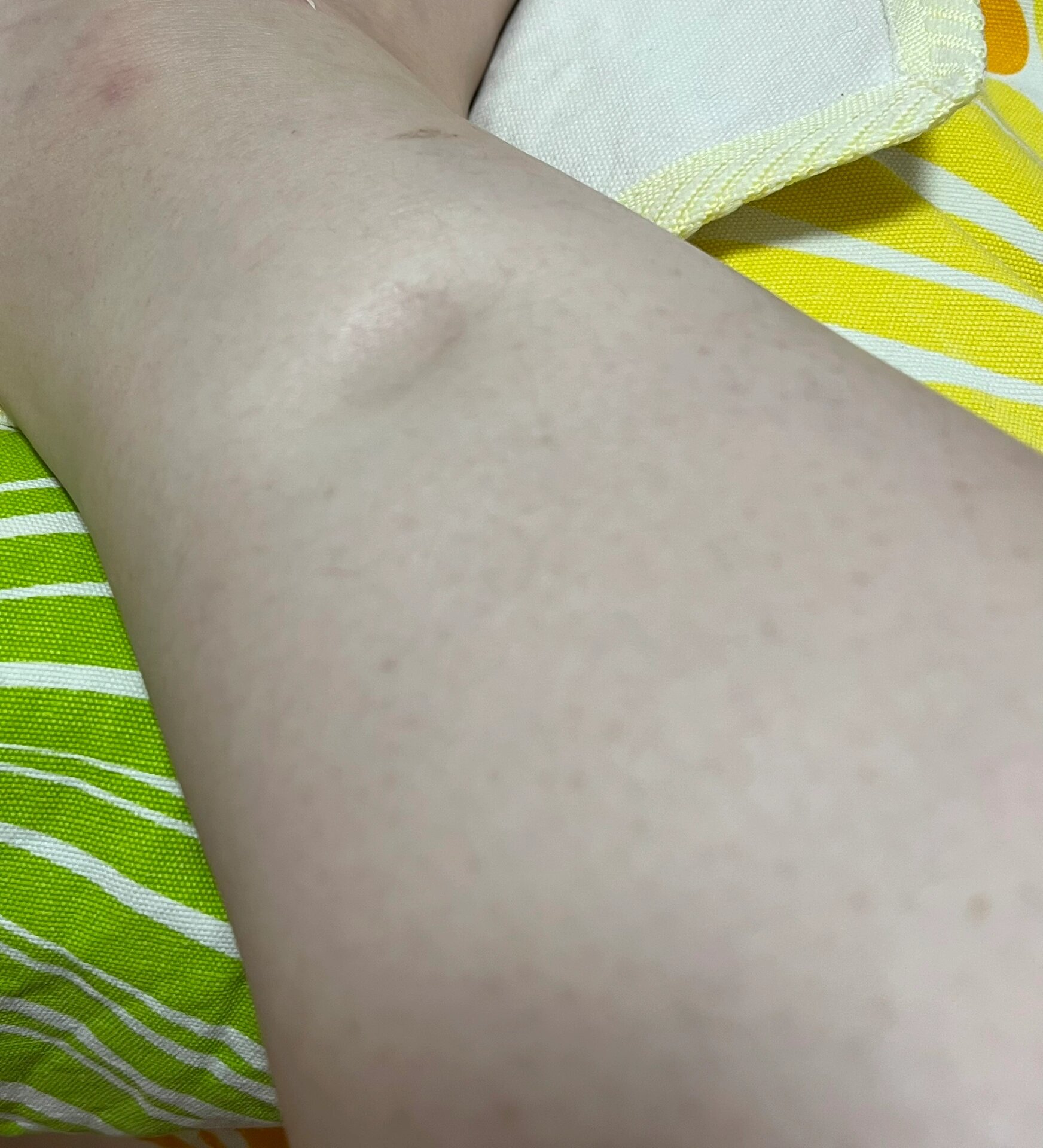 大家有小腿一按一个坑的情况吗 我不清楚是因为水肿导致的还是皮肤